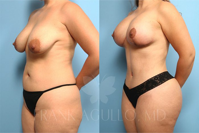 Brazilian Butt Lift Before and After 2