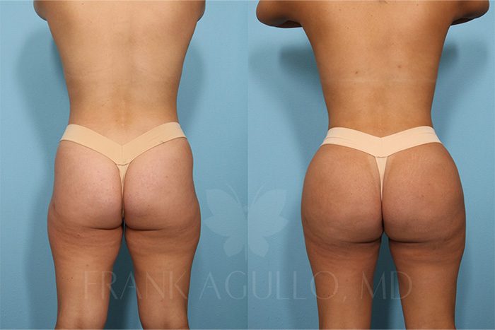 Brazilian Butt Lift Before and After 16
