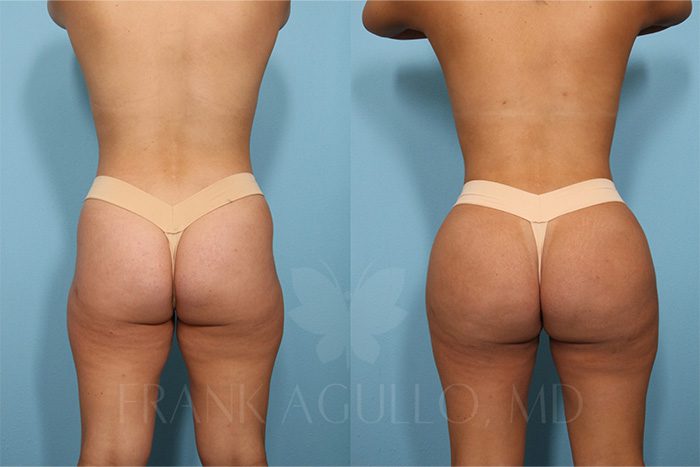 Brazilian Butt Lift Before and After 7