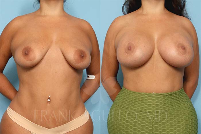 Breast Augmentation Before and After 1