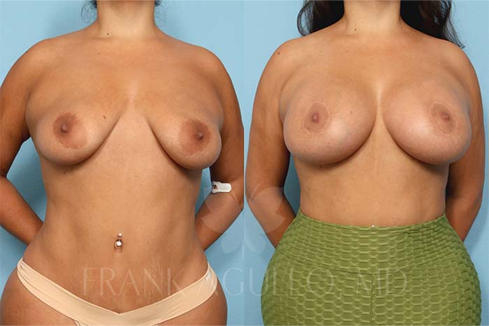 Breast Before and After 5