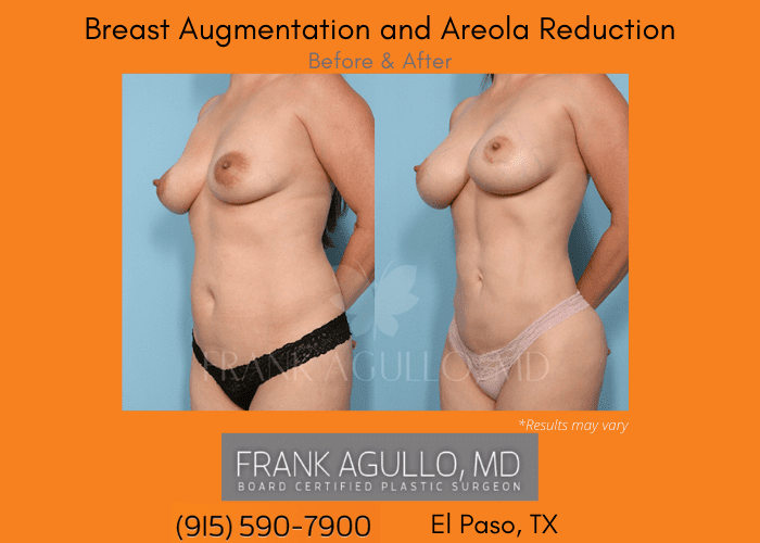 Before and after image showing the results of a breast like and areola reduction performed in El Paso, TX.