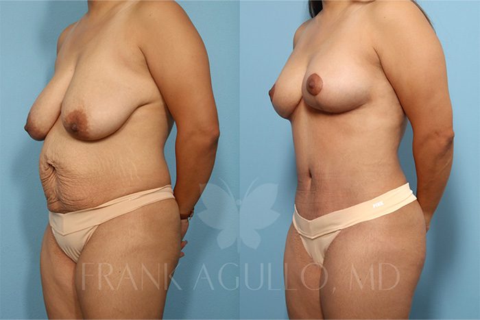 Breast Reduction Before and After 1