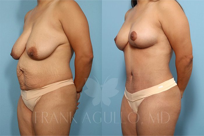 Breast Before and After 4