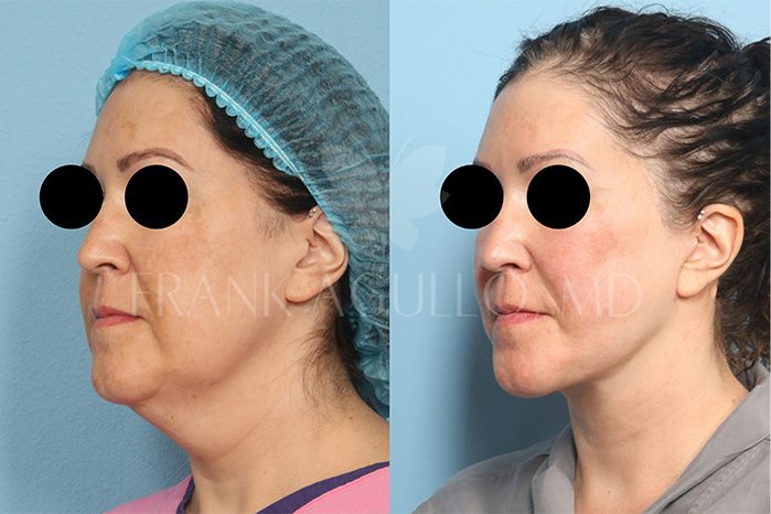 Neck Lift Before and After 4