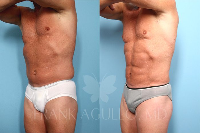 Liposuction Before and After 1