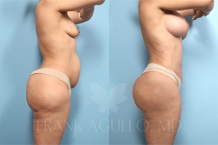 Mommy Makeover Before and After 3