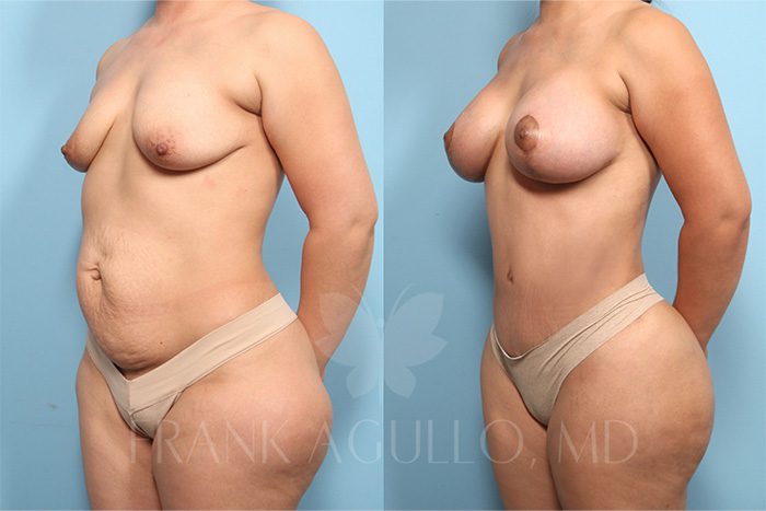 Mommy Makeover Before and After 2