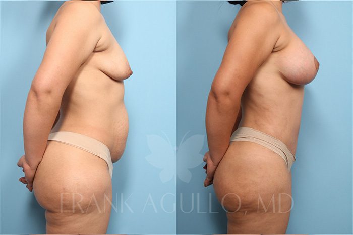 Mommy Makeover Before and After 4