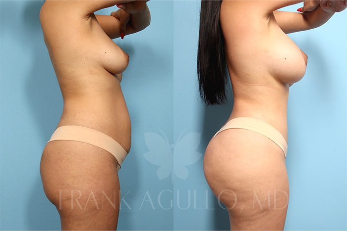 Mommy Makeover Before and After 2