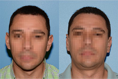 Otoplasty Before and After 2