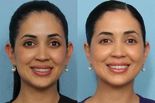 Otoplasty Before and After 1