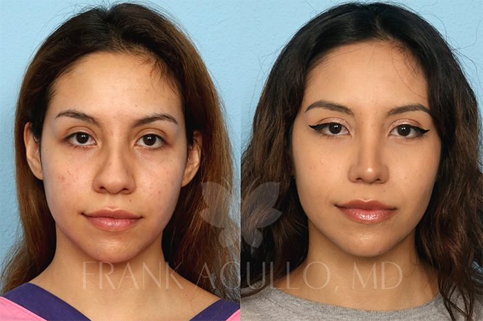 Rhinoplasty Before and After 8