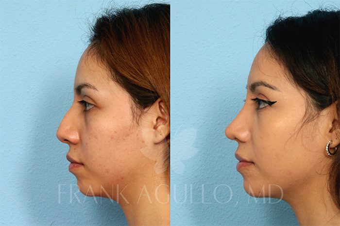 Rhinoplasty Before and After 2