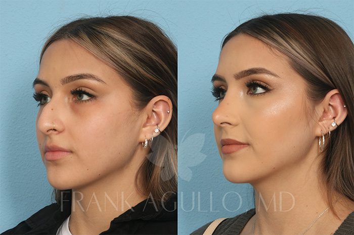Rhinoplasty Before and After 2