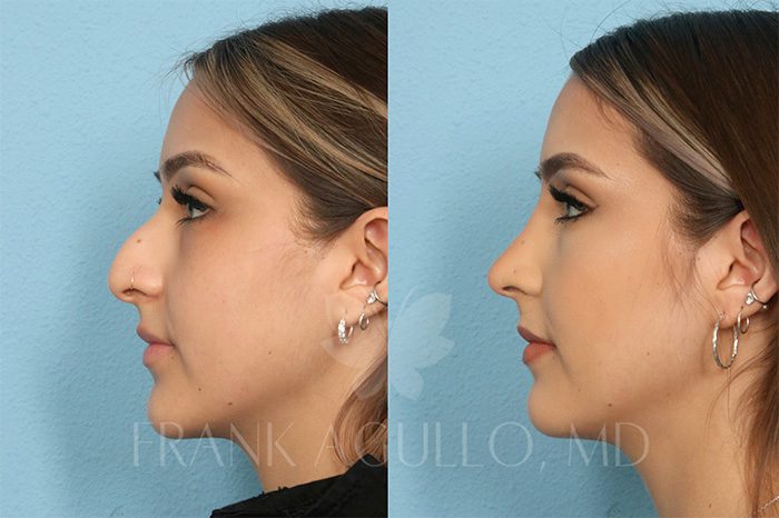 Rhinoplasty Before and After 3