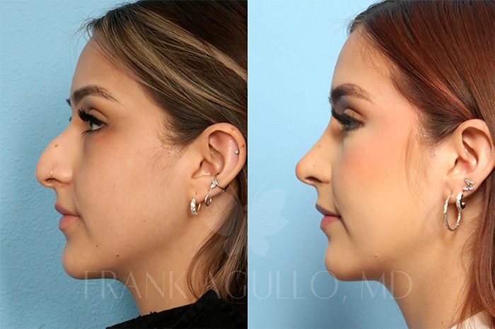 Rhinoplasty Before and After 4