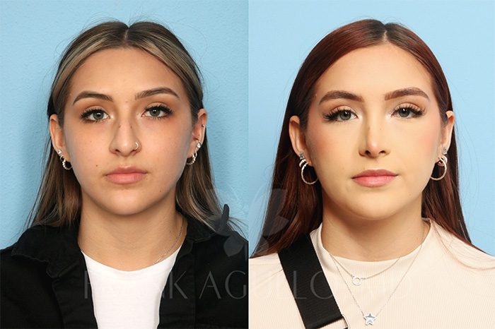 Rhinoplasty Before and After 7