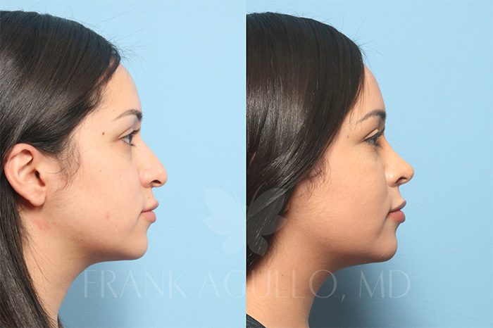Rhinoplasty Before and After 2