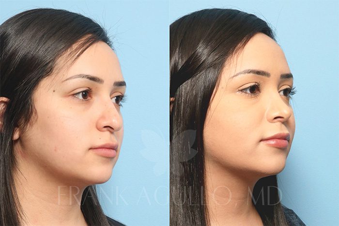 Rhinoplasty Before and After 3