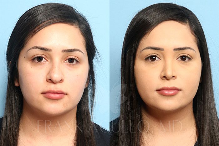 Rhinoplasty Before and After 6