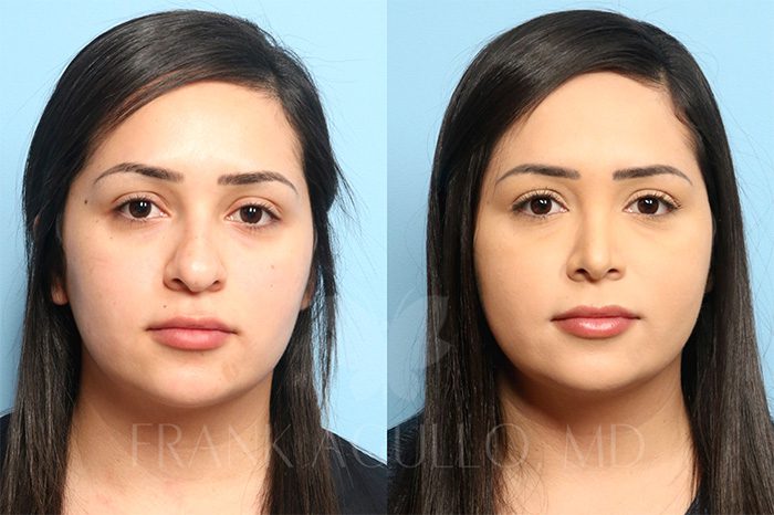 Face Before and After 13