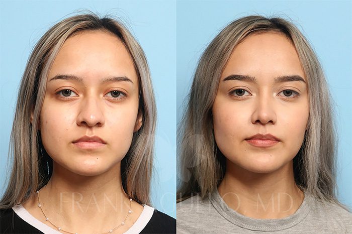Rhinoplasty Before and After 5