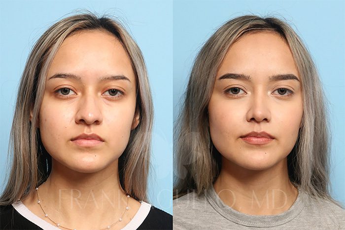 Face Before and After 12