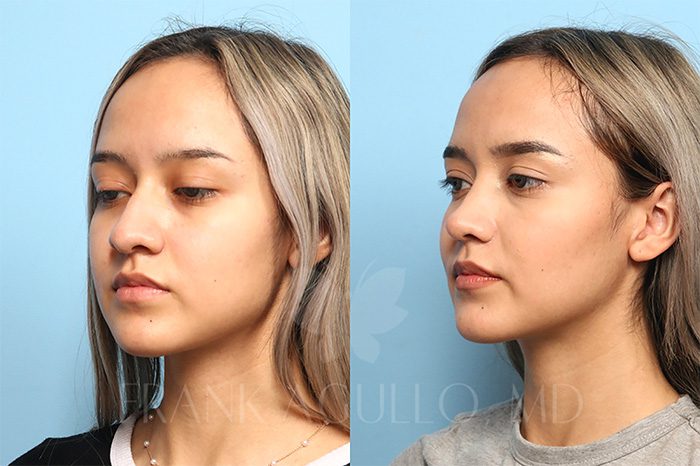 Rhinoplasty Before and After 2