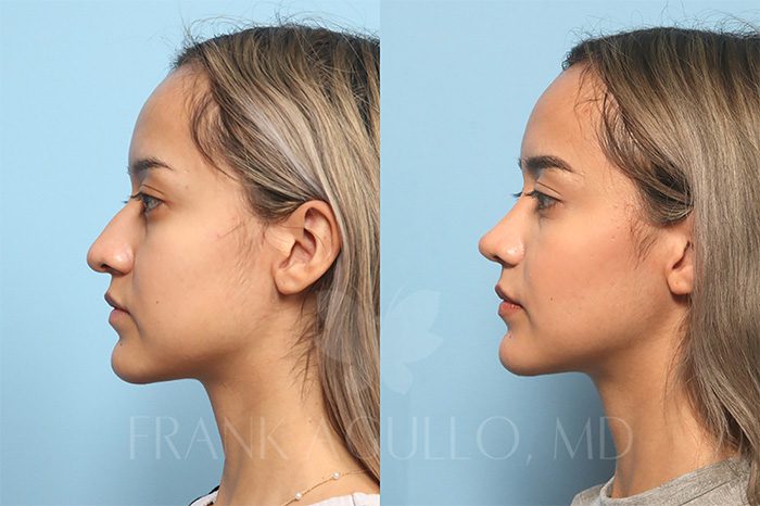 Rhinoplasty Before and After 3