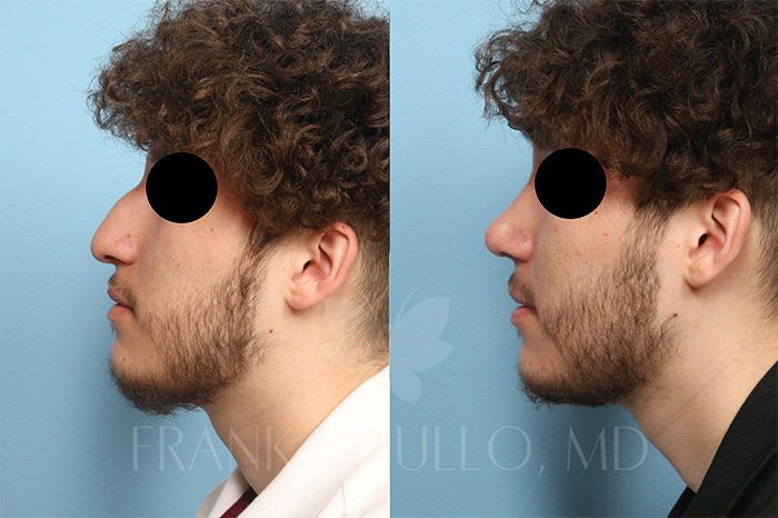 Rhinoplasty Before and After 2