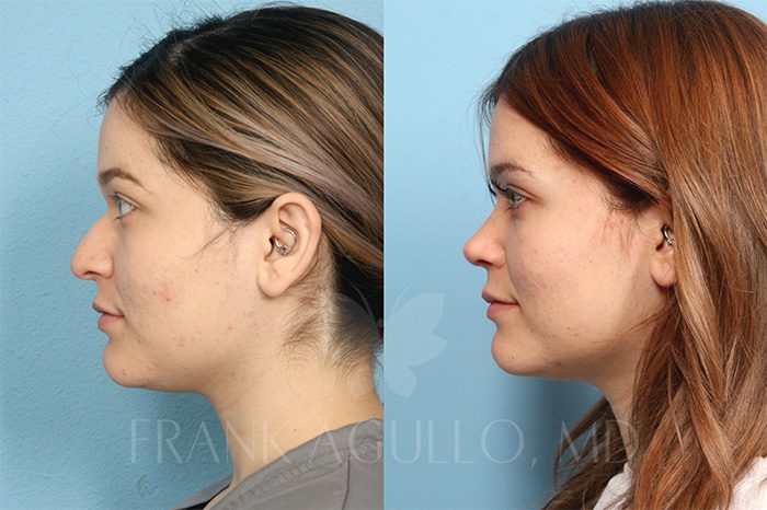 Rhinoplasty Before and After 2