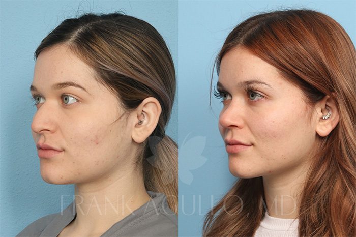 Rhinoplasty Before and After 3