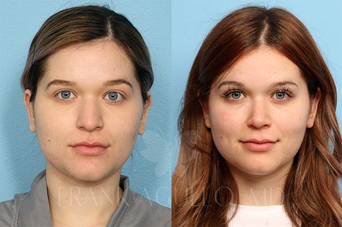 Rhinoplasty Before and After 3