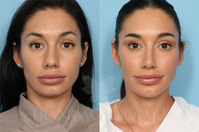 Rhinoplasty Before and After 2