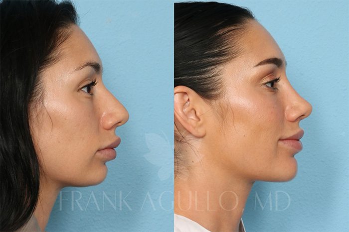 Rhinoplasty Before and After 2