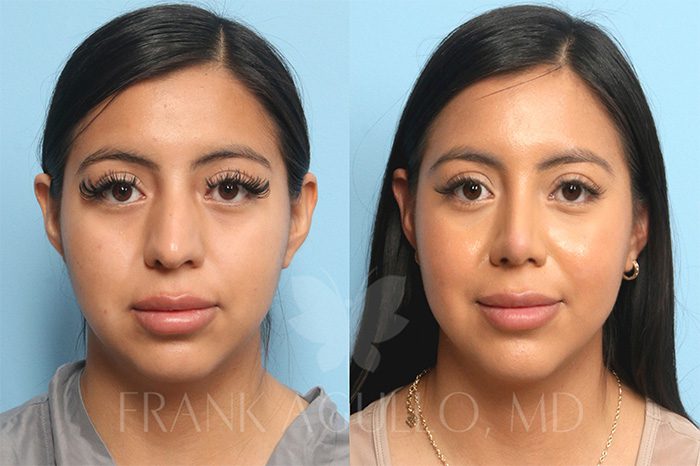 Face Before and After 8