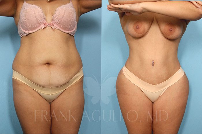 Tummy Tuck Before and After 6