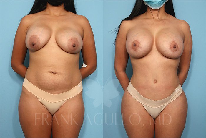 Tummy Tuck Before and After 5