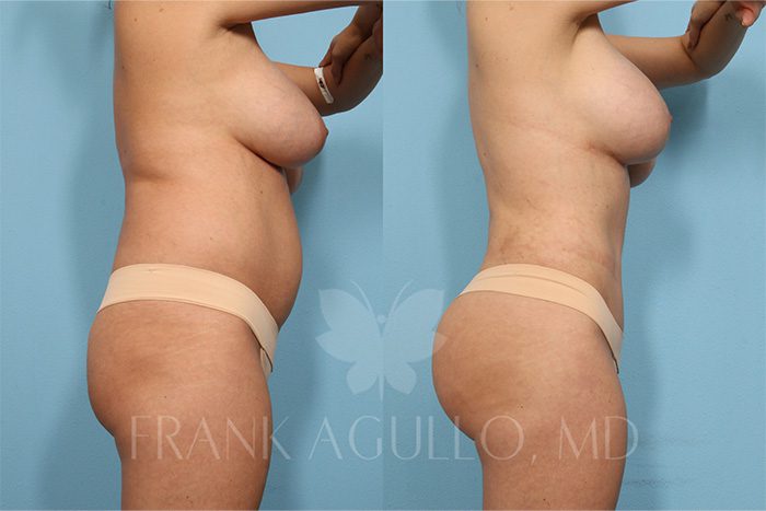 Tummy Tuck Before and After 2