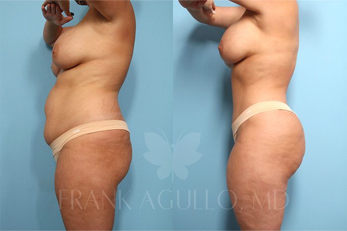 Tummy Tuck Before and After 2