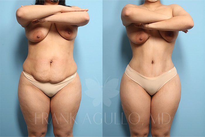 Tummy Tuck Before and After 2