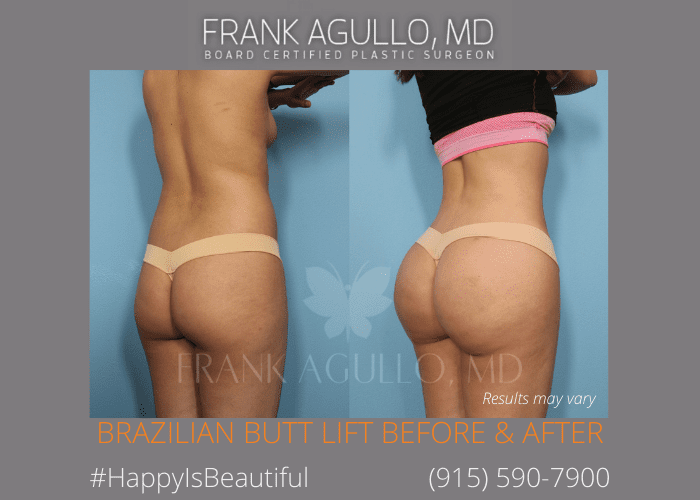 Before and after image showing the results of a Brazilian Butt Lift performed in El Paso, TX.