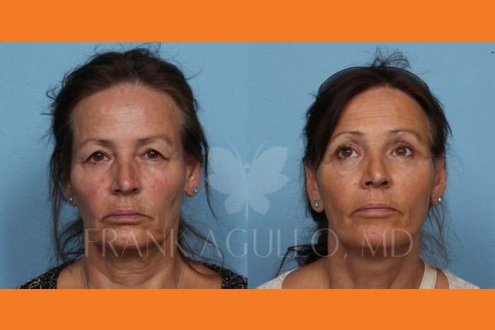 Neck Lift Before and After 2