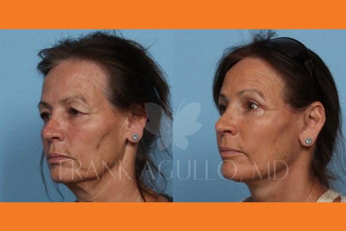 Neck Lift Before and After 2