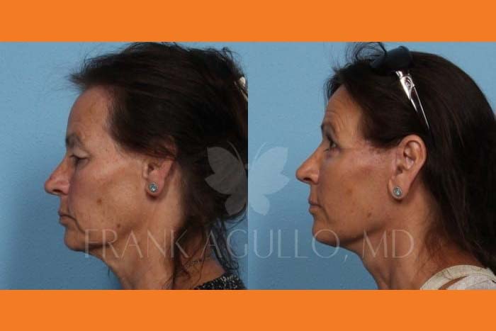 Neck Lift Before and After 3