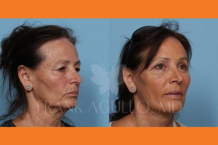 Neck Lift Before and After 4