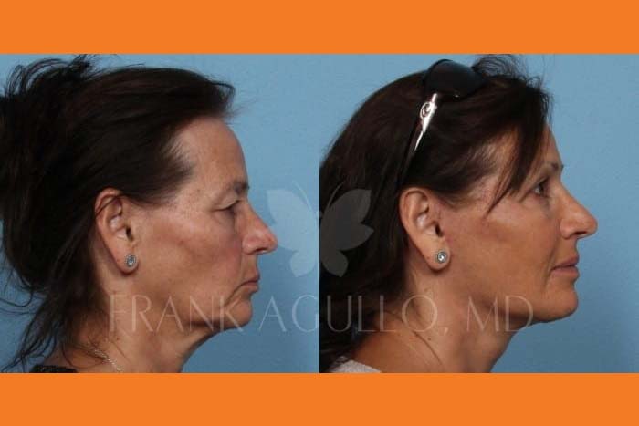 Neck Lift Before and After 5