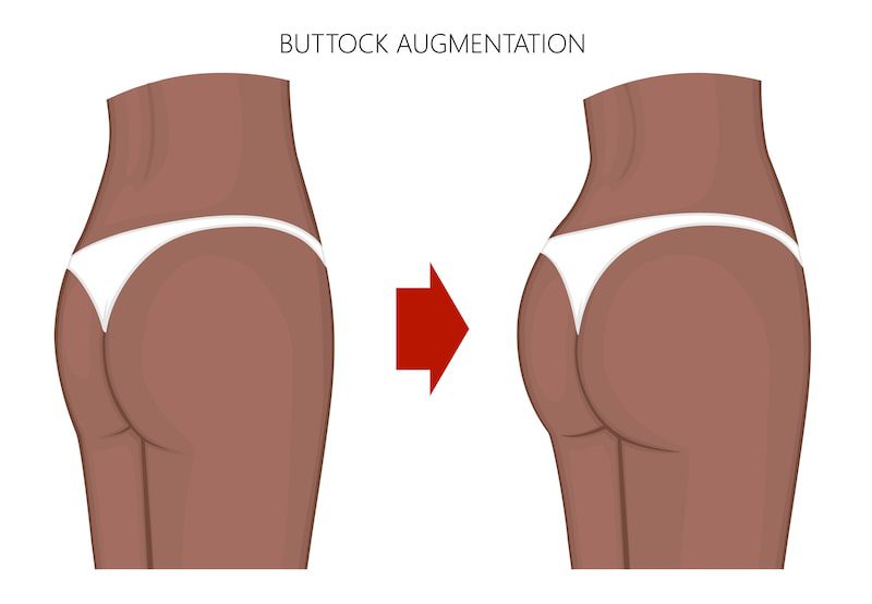 Vector illustration of buttock augmentation before and after.