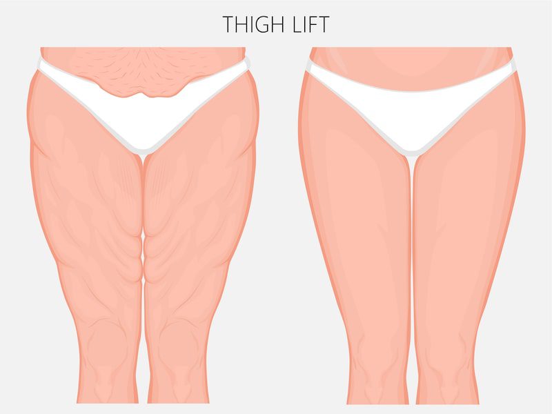 Vector illustration of a thigh lift before and after.